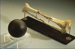 Sickles' Leg